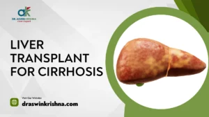 Liver Transplant for Cirrhosis